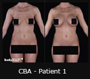 CBA - Patient1