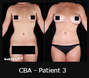 CBA - Patient3
