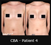 CBA - Patient4